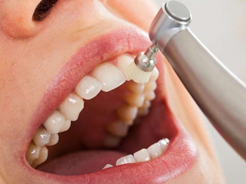 Limpieza dental INEFO