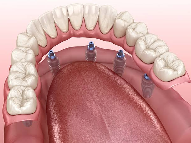 Prótesis sostenida por implantes INEFO