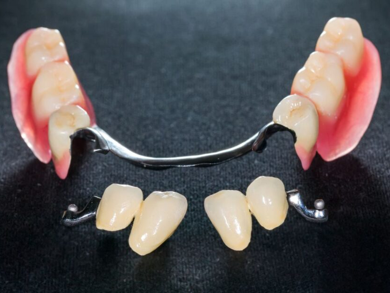 Puentes sobre dientes INEFO