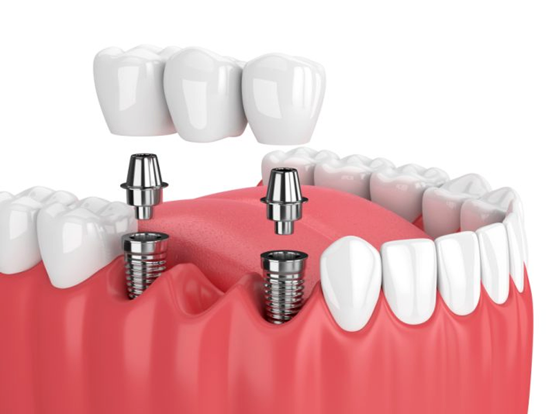 Puentes sobre implantes INEFO